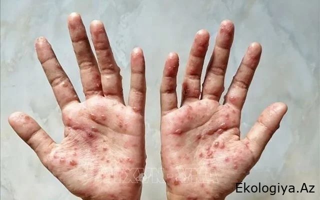 Dəhşətli virus yenidən yayılır: Fövqəladə vəziyyət elan olunacaq...