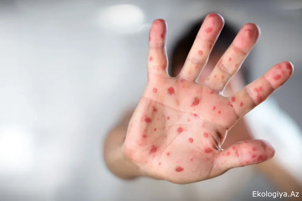 Hazırda Azərbaycanda qızılca və suçiçəyi ilə bağlı epidemioloji vəziyyət sabitdir - RƏSMİ Sağlamlıq